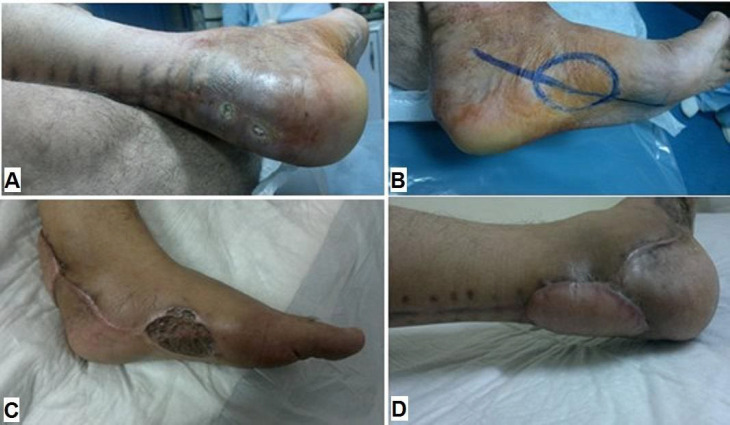 Versatility of Local Fasciocutaneous Island Flaps for Resurfacing Soft Tissue Defects Overlying the Achilles Tendon.