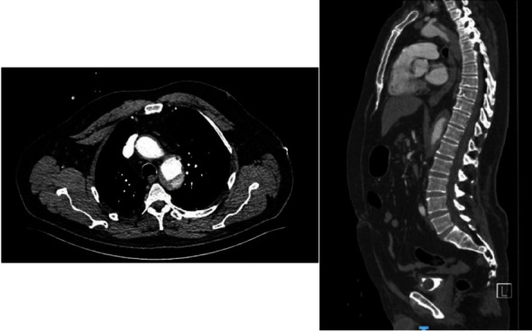 Spontaneous Recovery of Paraplegia in a Polytrauma Patient following Spinal Cord Ischemia due to Type B Traumatic Aortic Dissection.