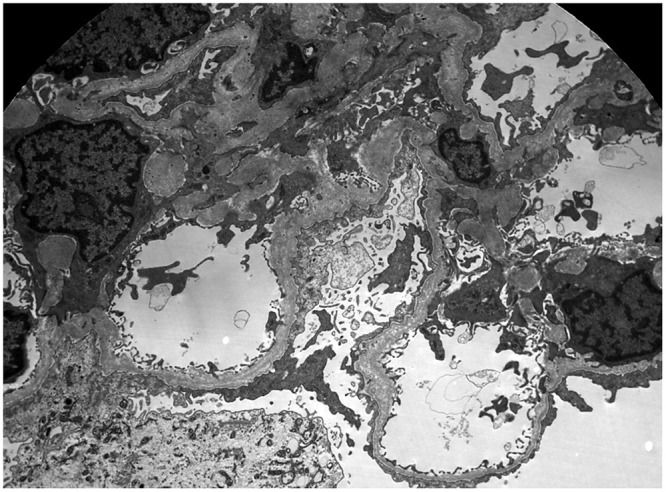 Genetic Susceptibility to Chronic Kidney Disease: Links, Risks and Management.