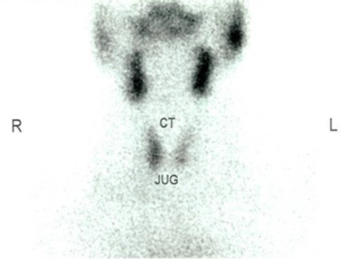 Thyroid Receptor Antibody and the Development of Graves' Orbitopathy: Clinical Experience of using Radioiodine Ablation in the Management of Graves' Orbitopathy in post-iodine ablation hypothyroid patient.