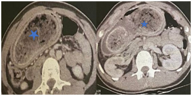 Trichobezoar: A Rare Cause of Gastric Obstruction.