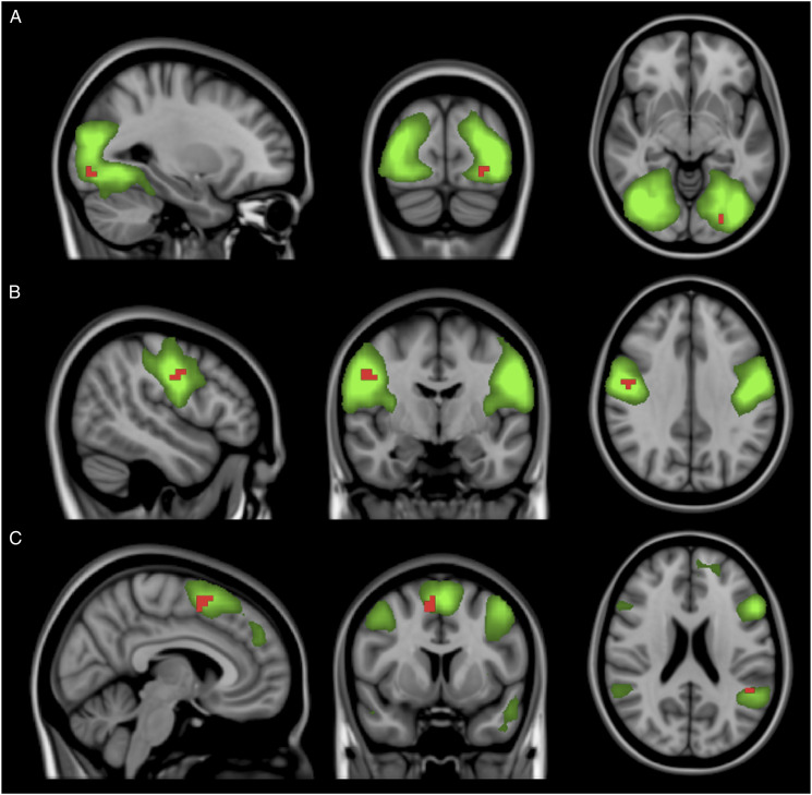 Influence of natalizumab on resting-state connectivity in patients with multiple sclerosis.