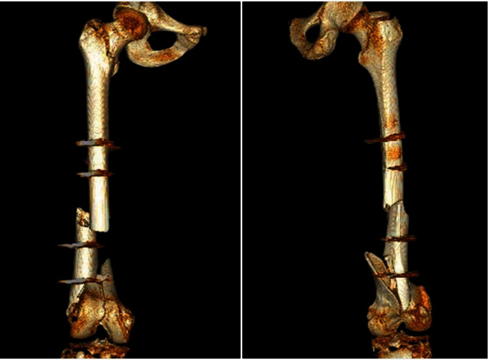 Spontaneous Recovery of Paraplegia in a Polytrauma Patient following Spinal Cord Ischemia due to Type B Traumatic Aortic Dissection.