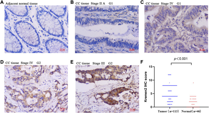 Increased Kremen2 predicts worse prognosis in colon cancer.