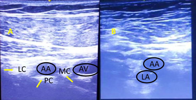 A Randomized Controlled Trial to Compare the Efficacy of Single versus Triple Injection Technique for Ultrasound-Guided Infraclavicular Block in Upper Limb Surgeries.