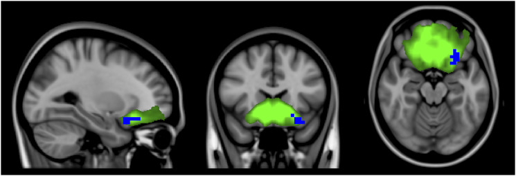 Influence of natalizumab on resting-state connectivity in patients with multiple sclerosis.