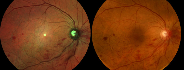 Comparison of Color Fundus Photography and Multicolor Fundus Imaging for Detection of Lesions in Diabetic Retinopathy and Retinal Vein Occlusion.