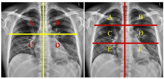 Assessing the implementation of COVID-19 structured reporting templates for chest radiography: a scoping review.