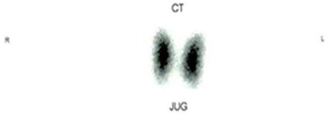 Thyroid Receptor Antibody and the Development of Graves' Orbitopathy: Clinical Experience of using Radioiodine Ablation in the Management of Graves' Orbitopathy in post-iodine ablation hypothyroid patient.