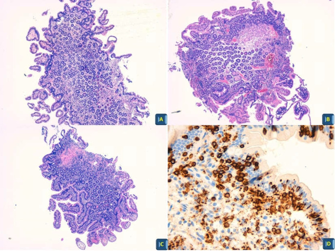 The correct methodological approach to the diagnosis of celiac disease: the point of view of the pathologist.