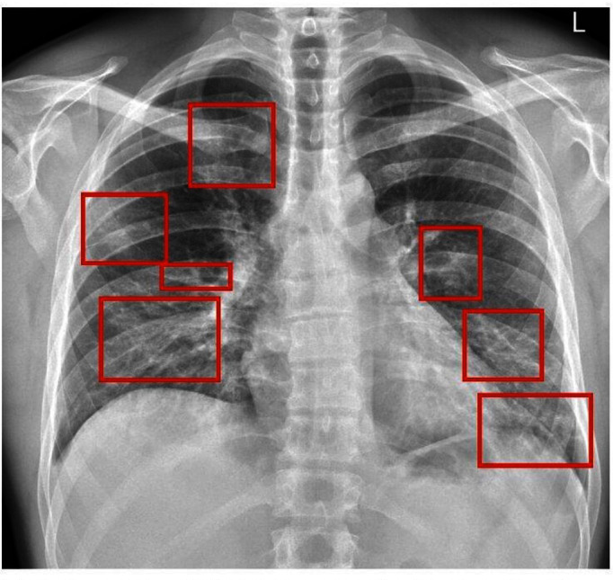 Assessing the implementation of COVID-19 structured reporting templates for chest radiography: a scoping review.