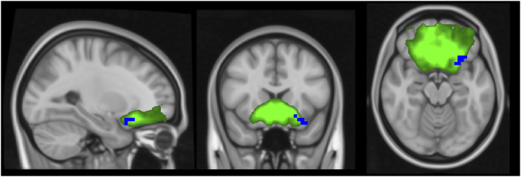 Influence of natalizumab on resting-state connectivity in patients with multiple sclerosis.