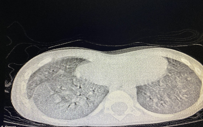 Surfactant Deficiency Causing Severe Pneumonia in a Child.