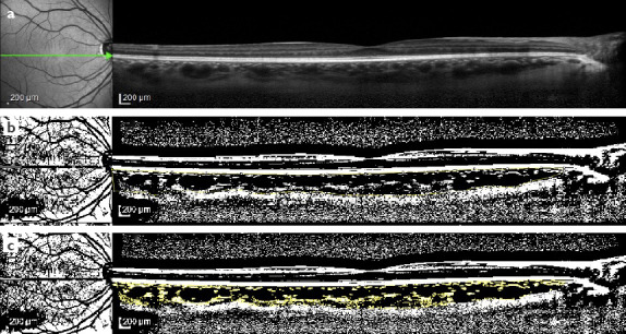 Assessment of Choroidal Vascularity in Inactive Thyroid Associated Orbitopathy.