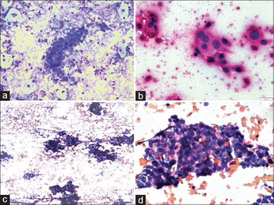 Role of Guided FNA in Gallbladder Cancer: A Retrospective 3-Year Study.