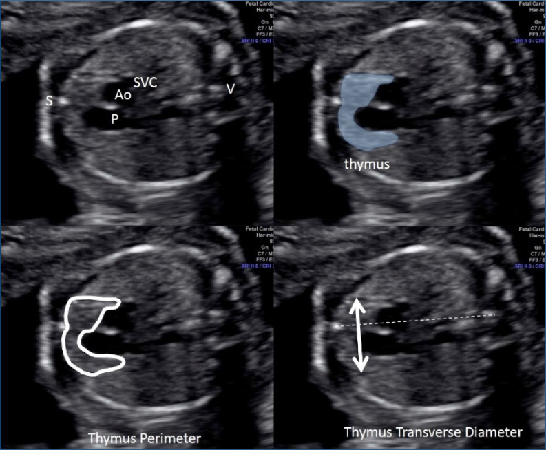 An enlarged fetal thymus may be the initial response to intrauterine inflammation in pregnant women at risk for preterm birth.