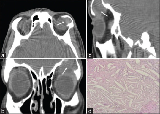 Orbital Cholesterol Granuloma: Report of Two Cases.