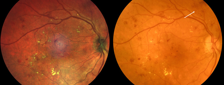 Comparison of Color Fundus Photography and Multicolor Fundus Imaging for Detection of Lesions in Diabetic Retinopathy and Retinal Vein Occlusion.