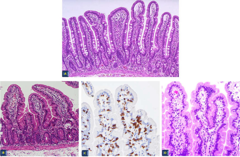 The correct methodological approach to the diagnosis of celiac disease: the point of view of the pathologist.