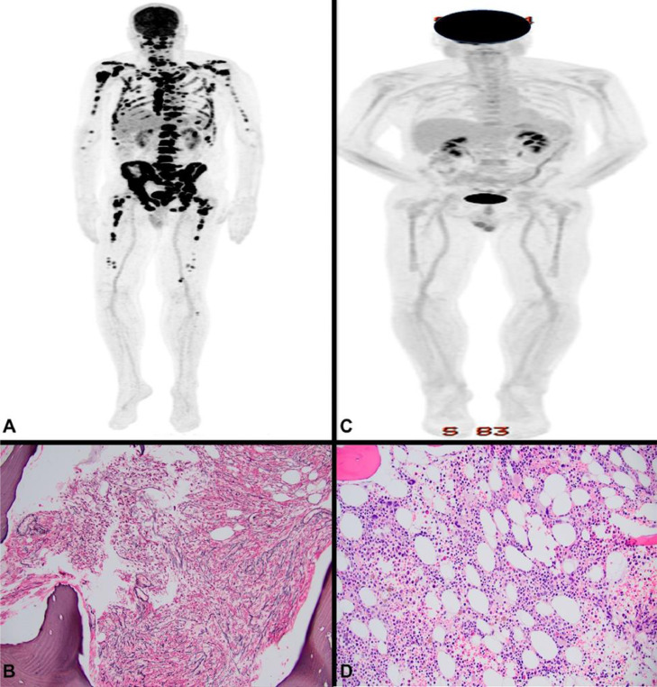 Aggressive chronic lymphocytic leukemia masked by extensive marrow fibrosis