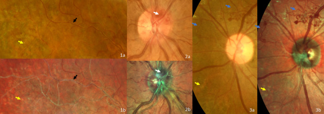 Comparison of Color Fundus Photography and Multicolor Fundus Imaging for Detection of Lesions in Diabetic Retinopathy and Retinal Vein Occlusion.