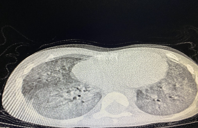 Surfactant Deficiency Causing Severe Pneumonia in a Child.