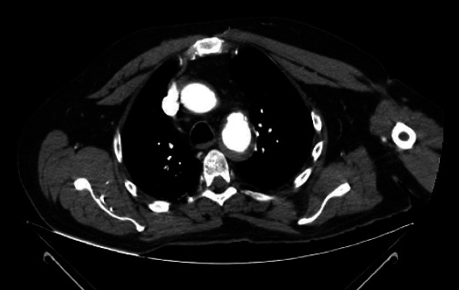 Spontaneous Recovery of Paraplegia in a Polytrauma Patient following Spinal Cord Ischemia due to Type B Traumatic Aortic Dissection.