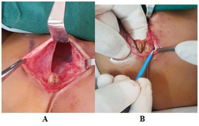 Isolated V-Shaped Sternal Cleft - A Rare Chest Wall Malformation.