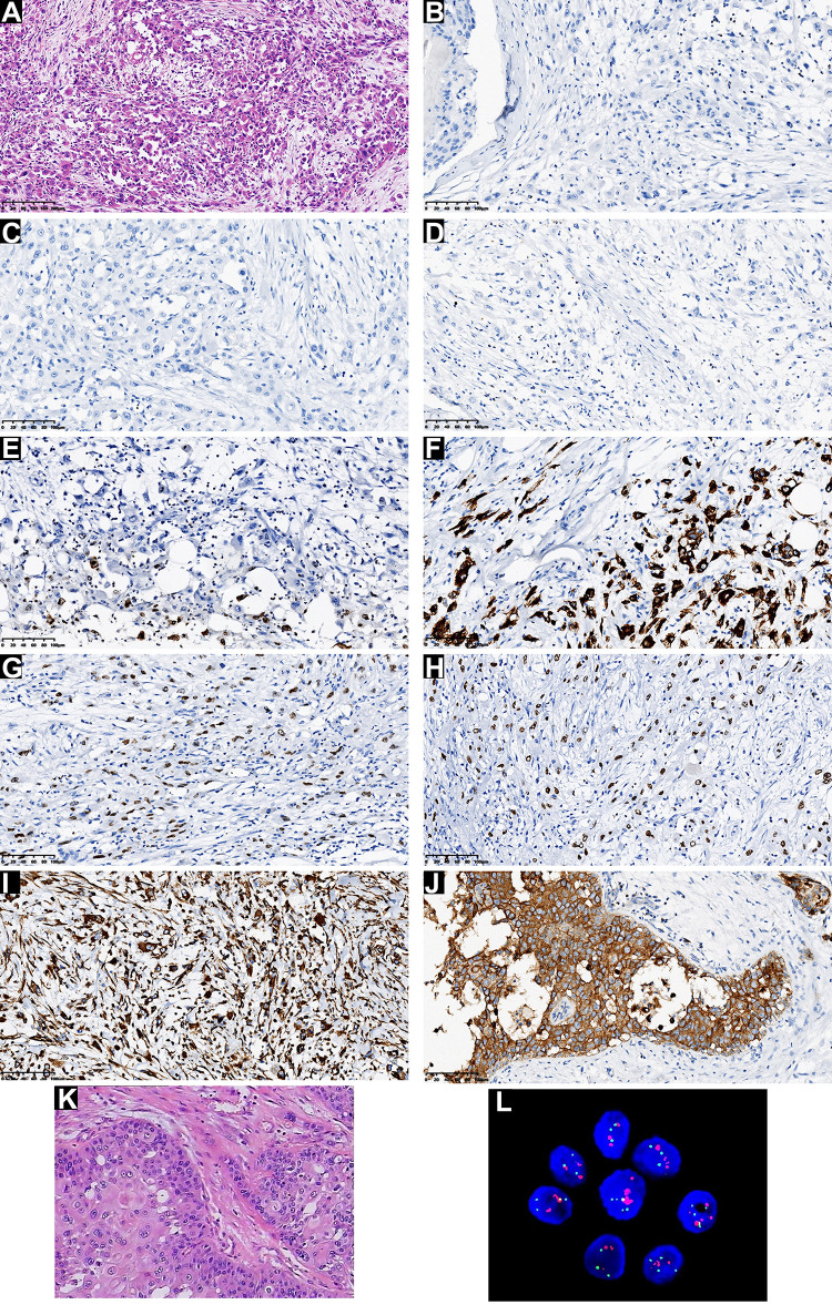 Recurrent Metaplastic Breast Cancer with Subtype Converted from Triple-Negative to HER2-Positive: A Case Report and Literature Review.