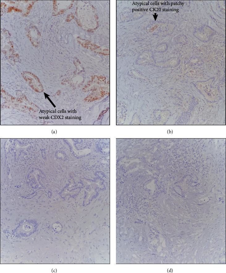 A Rare Case of Ruptured Tailgut Cyst Leading to Carcinomatosis.