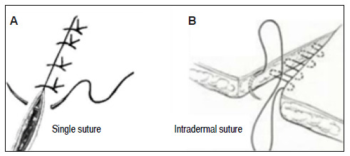 COMPARATIVE EVALUATION OF SKIN SUTURE IN RATS WITH POLYGLYCAPRONE 25 AND NYLON.