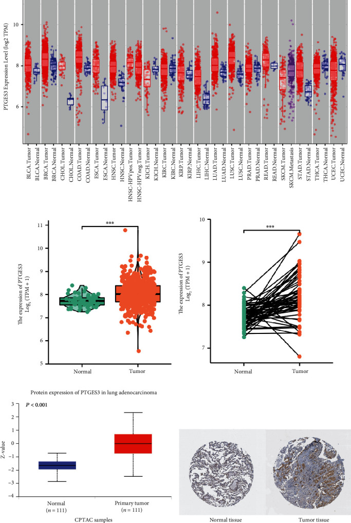 Effect of PTGES3 on the Prognosis and Immune Regulation in Lung Adenocarcinoma.