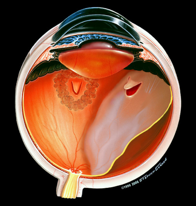 Preventing Retinal Detachment: The Encircling Laser Retinopexy Technique.