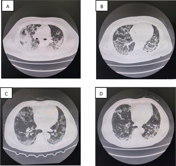 Early Awake Prone Position Combined with High-Flow Nasal Oxygen Therapy in Severe COVID-19: A Case Series.