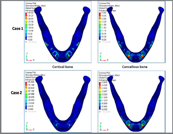 Comparative evaluation of displacement and stress distribution pattern during mandibular arch distalization with extra and inter-radicular mini-implants: a three-dimensional finite element study.