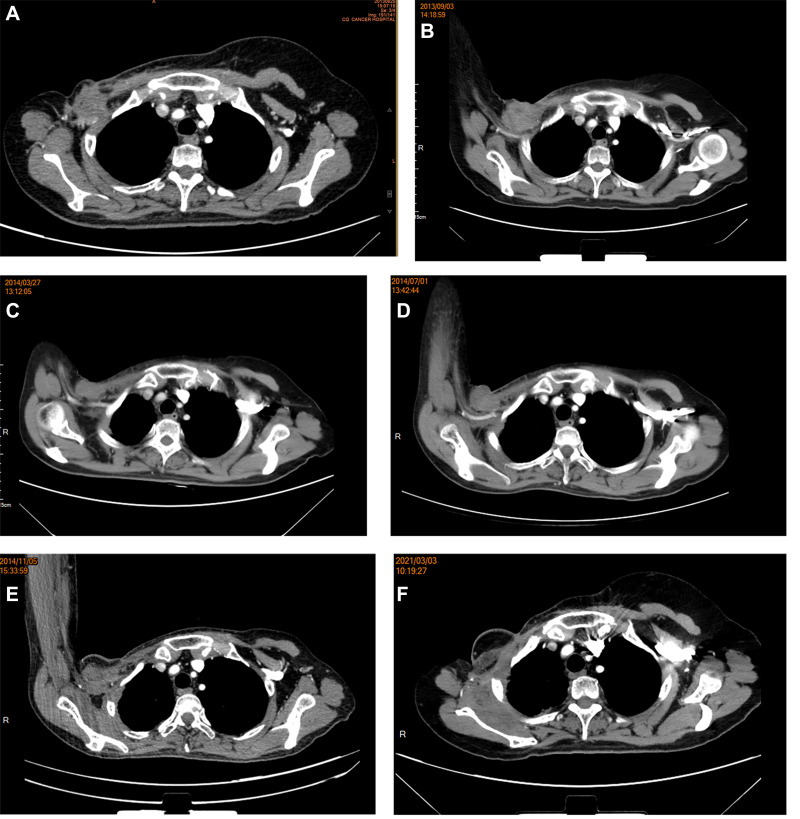 Recurrent Metaplastic Breast Cancer with Subtype Converted from Triple-Negative to HER2-Positive: A Case Report and Literature Review.