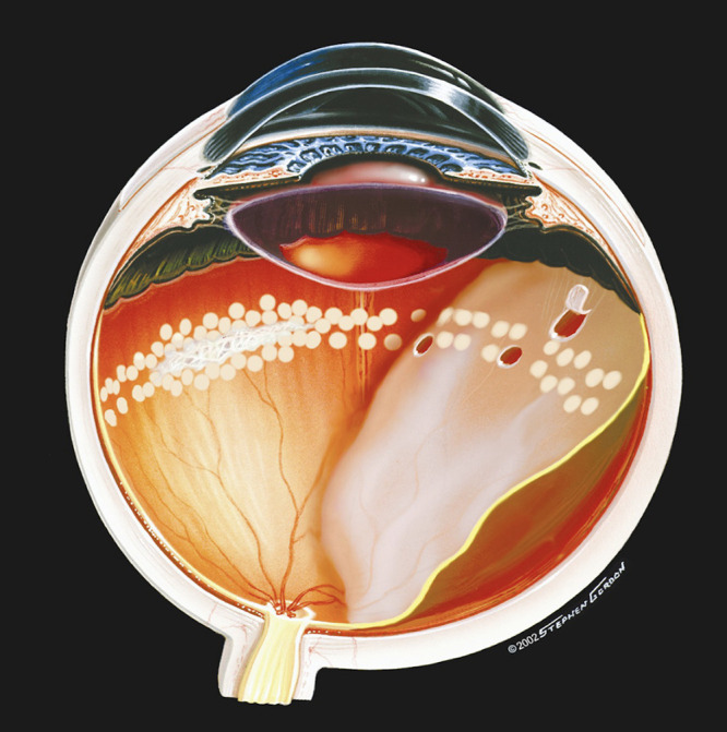 Preventing Retinal Detachment: The Encircling Laser Retinopexy Technique.