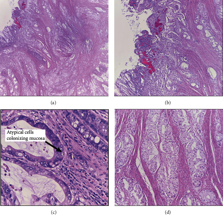 A Rare Case of Ruptured Tailgut Cyst Leading to Carcinomatosis.