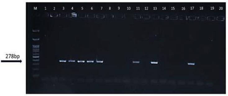 Human BKV large T genome detection in prostate cancer and benign prostatic hyperplasia tissue samples by nested PCR: A case-control study.