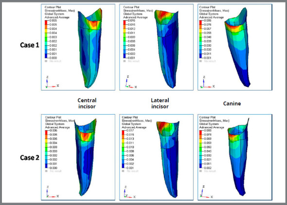 Comparative evaluation of displacement and stress distribution pattern during mandibular arch distalization with extra and inter-radicular mini-implants: a three-dimensional finite element study.