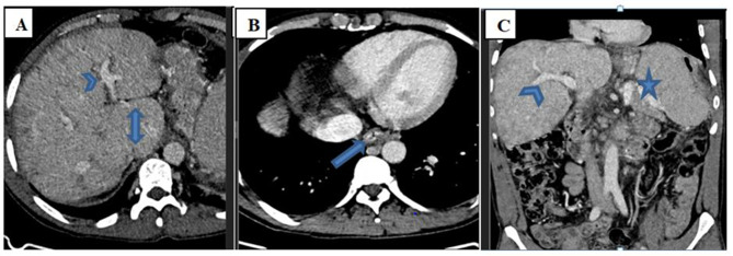 Budd-Chiari Syndrome as an Initial Presentation of Systemic Lupus Erythematosus Associated with Antiphospholipid Syndrome: A Case Report with Review of the Literature.