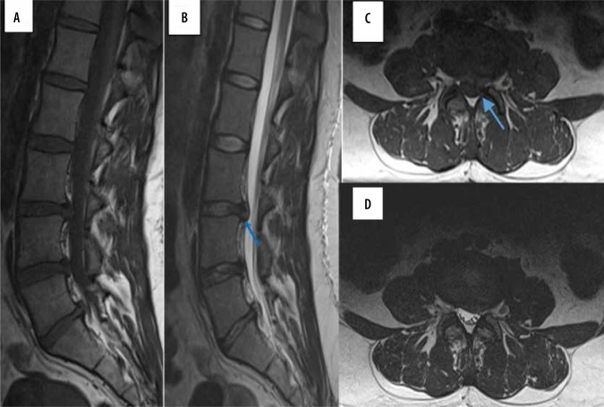 Children with back pain - a radiologist's approach.