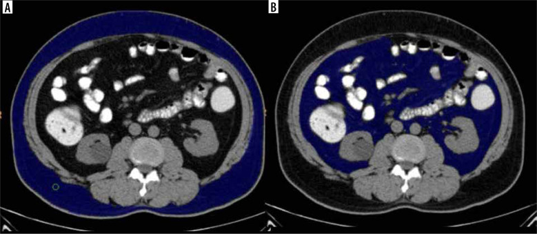 Computed tomographic abdominal fat volume estimation - a handy tool to predict the risk of metabolic syndrome.