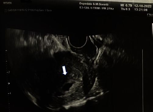 Recurrent Hydatidiform Moles: A Clinical Challenge-A Case Report and an Update on Management and Therapeutical Strategies.