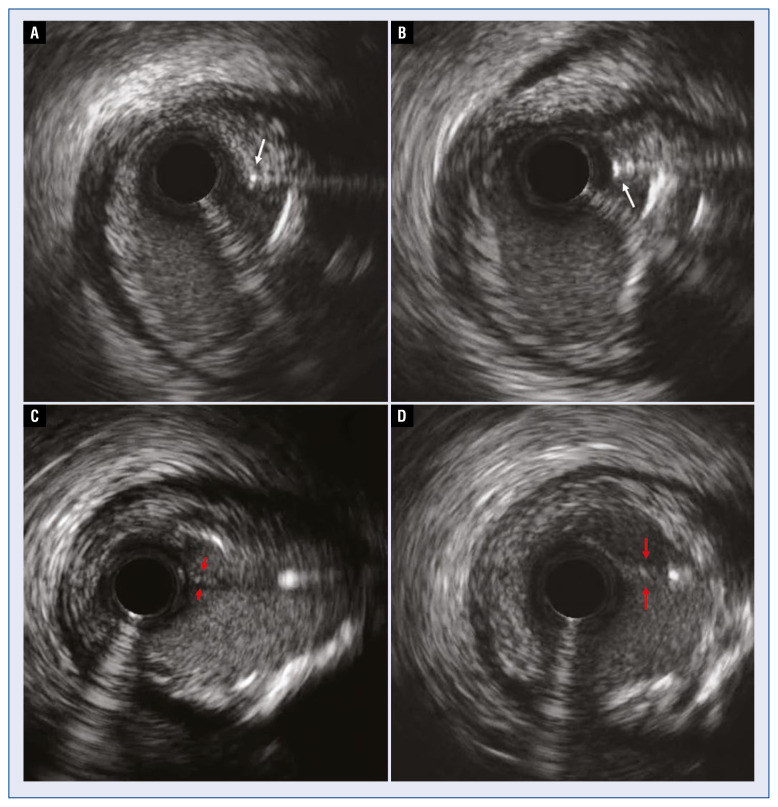 Subintimal shift as mechanism for side-branch occlusion in percutaneous treatment of chronic total occlusions with bifurcation lesions.