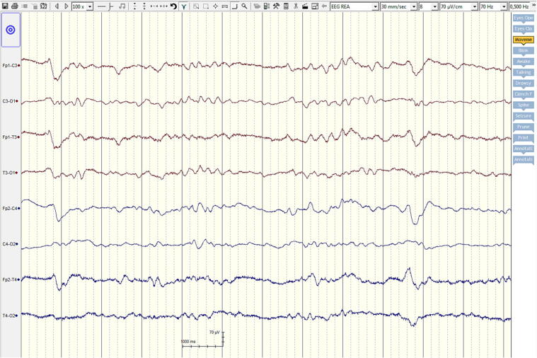 Rapid response EEG with needle electrodes in an intensive care unit with limited resources