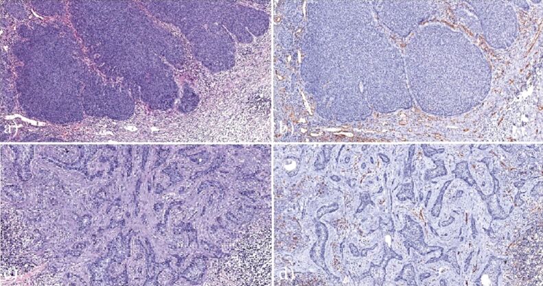 Morphological aspects of basal cell carcinoma vascularization.