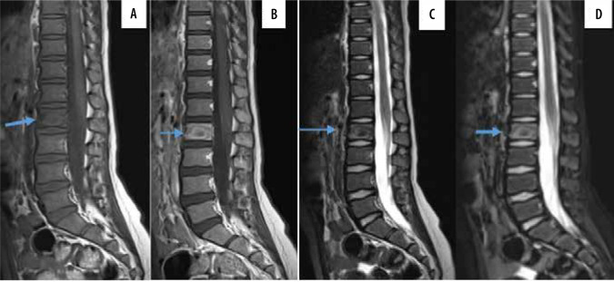 Children with back pain - a radiologist's approach.