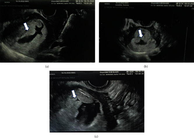 Recurrent Hydatidiform Moles: A Clinical Challenge-A Case Report and an Update on Management and Therapeutical Strategies.