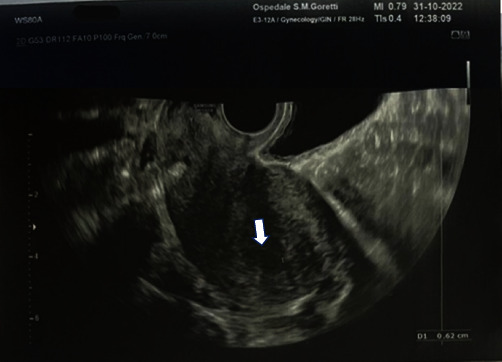 Recurrent Hydatidiform Moles: A Clinical Challenge-A Case Report and an Update on Management and Therapeutical Strategies.